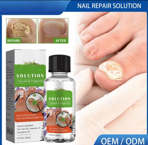 Treats any form of nail impair. This is a solution for those who have problems with nail growth. You can easily repair them and replace old ones with new ones. Very effective and treats well